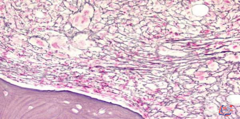 تليف نخاع العظم Myelofibrosis