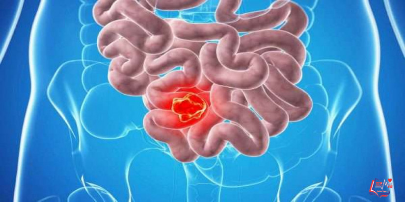 متلازمة لينش Lynch syndrome