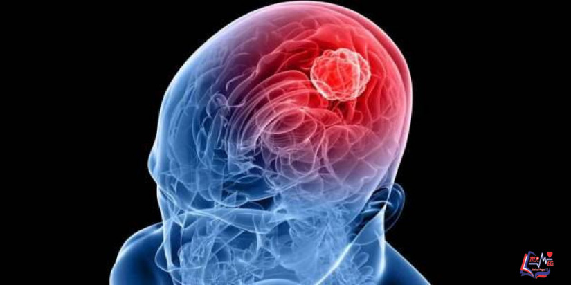 ورم جليوبلاستوما Glioblastoma