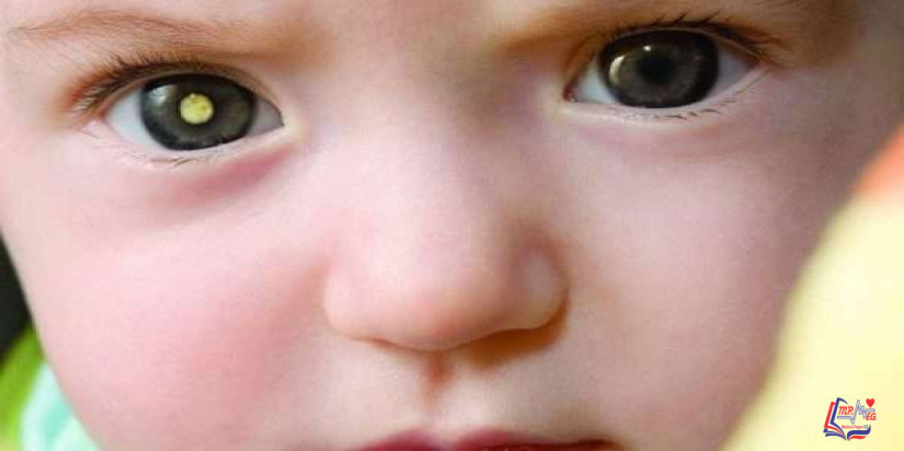 الورم الارومي الشبكي Retinoblastoma