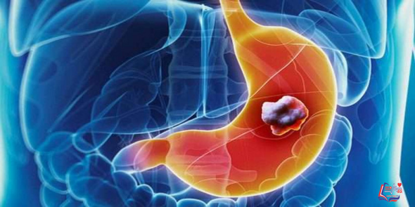 سرطان المعدة Stomach cancer