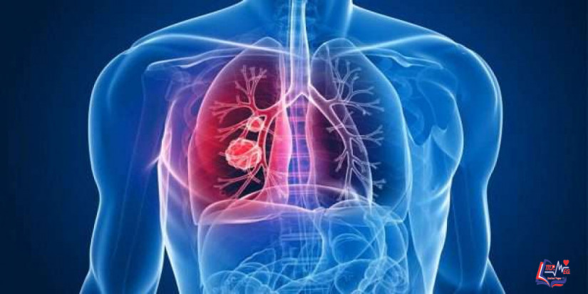 ورم المتوسطة Mesothelioma