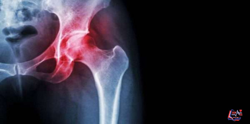 كسر الورك Hip Fracture