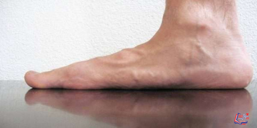 القدم المسطحة (فلات فوت) Flatfeet