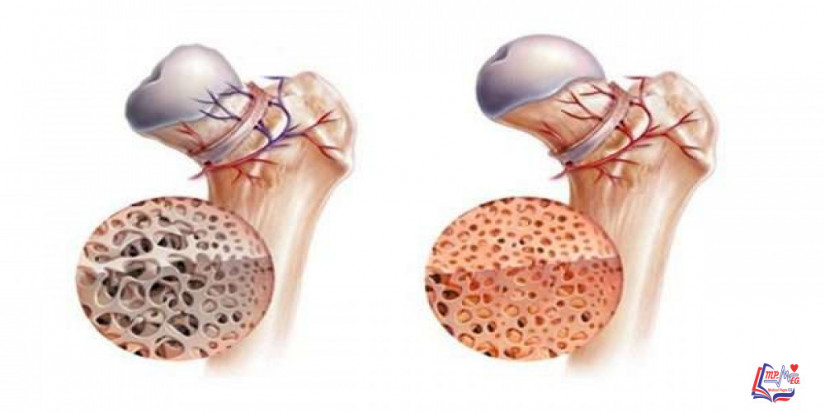 تنخر العظام aseptic necrosis