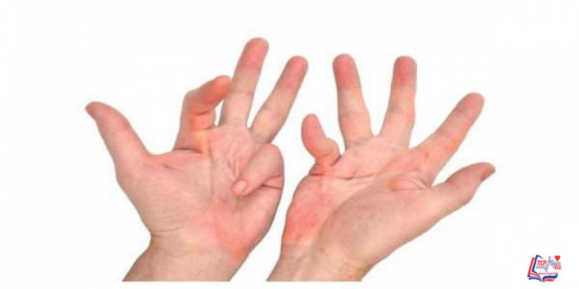 تقلصات دوبويترن Dupuytrens contractures