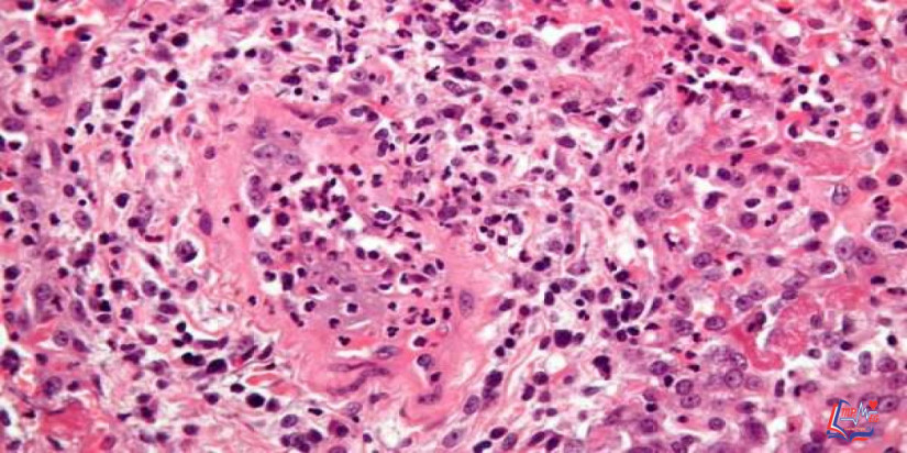 داء فاغنر Wegeners granulomatosis