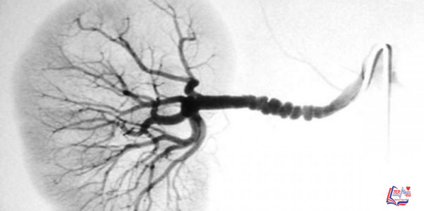 خلل التنسج الليفي العضلي Fibromuscular dysplasia