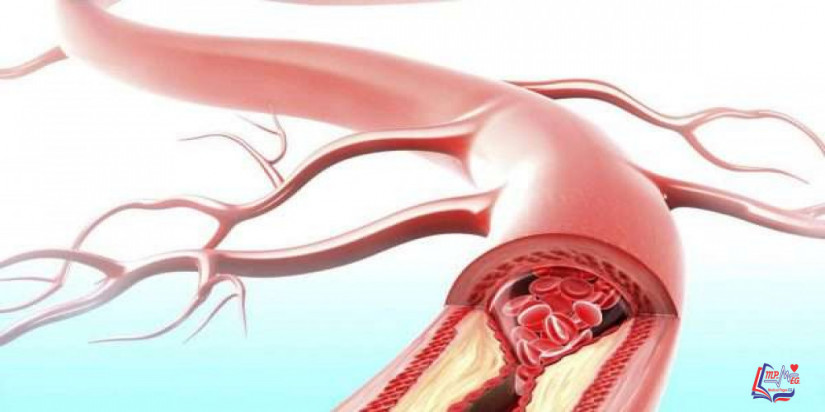 التهاب الشرايين العقدي Polyarteritis nodosa
