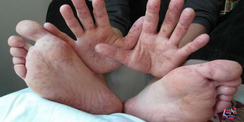 مرض فيروس كوكساكى Coxsackie virus