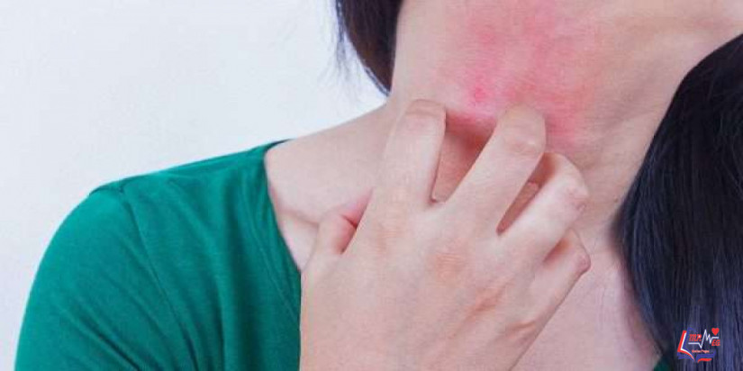 الجذام leprosy