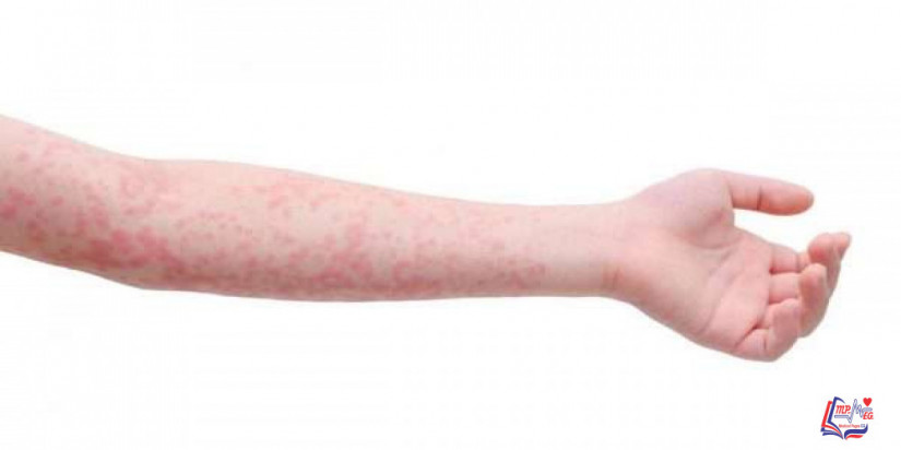 الحمى القرمزية Scarlet fever