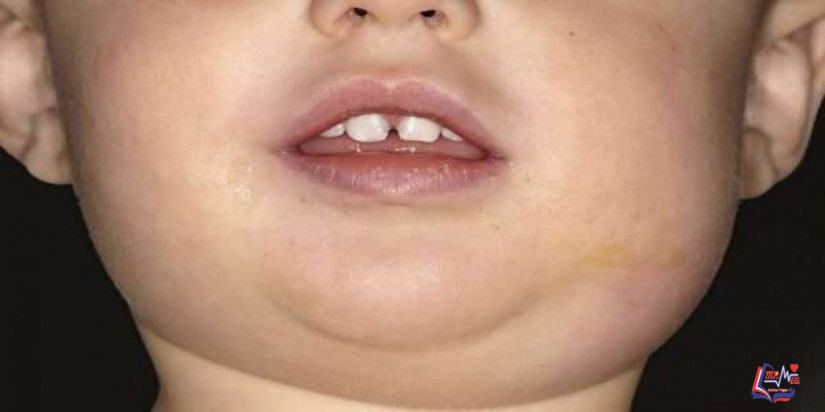 التهاب الغدة النكفية Mumps
