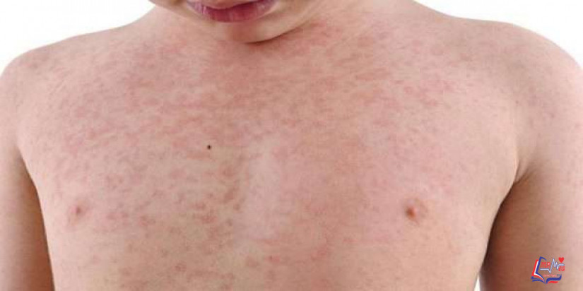 الحصبة الالمانية Rubella