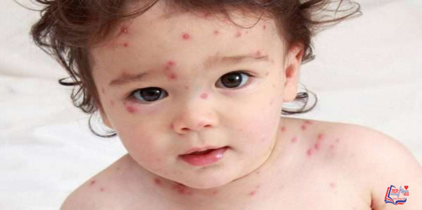 جدري الماء Chickenpox