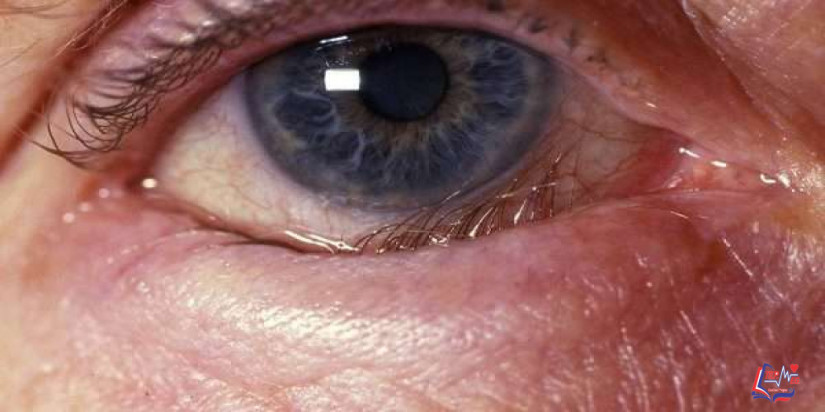الشتر الداخلي لجفن العين Entropion