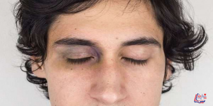 العين السوداء Black eye
