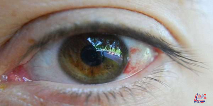 نزيف تحت الملتحمة Subconjunctival hemorrhage